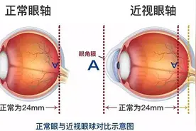 46岁男子右眼频频出问题 每次都和高度近视有关图片