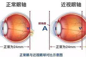 46岁男子右眼频频出问题 每次都和高度近视有关图片