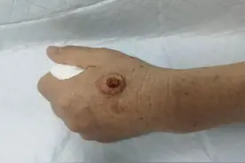 因膏药反复刺激，湖南70岁奶奶手上的小肿物竟恶化成癌图片