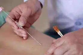 科学减重｜中医穴位埋线，180斤小伙半年瘦30斤图片