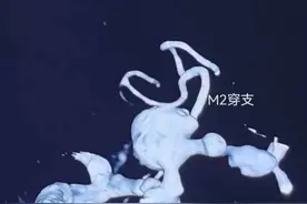 复杂脑血管病克星，一期复合手术一站式完成外科手术和介入治疗图片