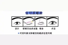 济南海峡整形科普：关于双眼皮修复，那些你不知道的事图片