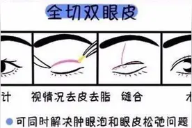 济南海峡整形科普：关于双眼皮修复，那些你不知道的事图片