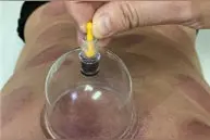 使用真空拔罐器居家自我保健的操作方法图片