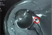 宿迁市钟吾医院骨科开展肩关节镜下盂唇修补术，解决习惯性脱位图片