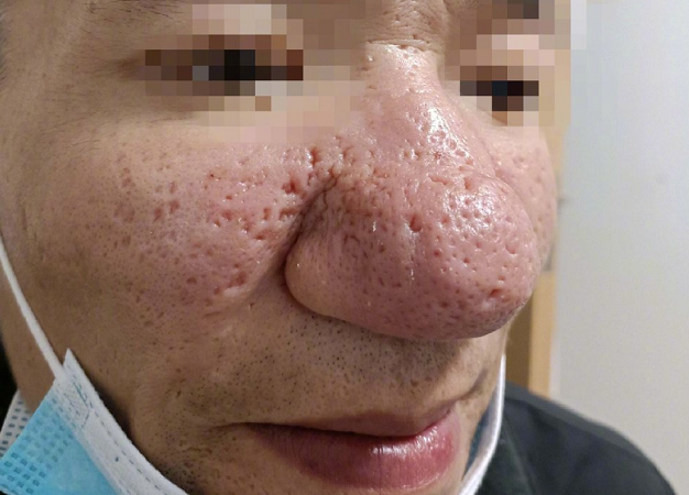 发展到一定程度会表现为鼻部结缔组织增生,皮脂腺异常增大形成鼻赘