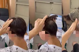 00后小伙头顶“寸草不生”，31岁白领脊髓变形……别再跟身体开玩笑了，你玩不过的图片