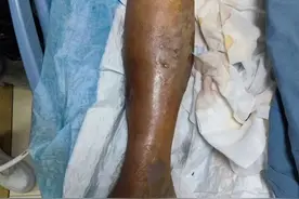 女子在海边玩一下午后，第4天竟被截肢！医生惊叹：该病症此前只在教科书上见过图片