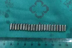 东营10岁男孩尿道塞入22个磁力柱 医生紧急手术全部取出图片