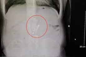 拦都拦不住！男子醉酒吞下打火机！医生取出后居然还能打着火图片