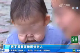 揪心！2岁男童患怪病，皮肤松弛下垂面貌形似老人，病因却查不出视频封面