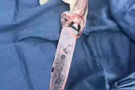 20厘米尖刀刺入腹中仅露刀柄 患者在安徽医院获成功救治图片