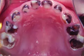 健康小站播报｜3岁小姑娘竟有14颗蛀牙！医生的一番话，让家长恍然大悟图片