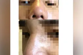 济南喜悦整形男性顾客发声：肋骨鼻术失败，修复两次致鼻歪斜视频封面