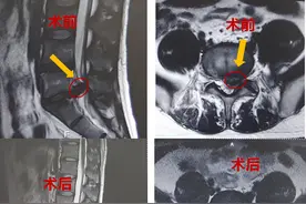 通过7毫米的小切口治好腰椎间盘突出，松江医生怎么做到的？图片