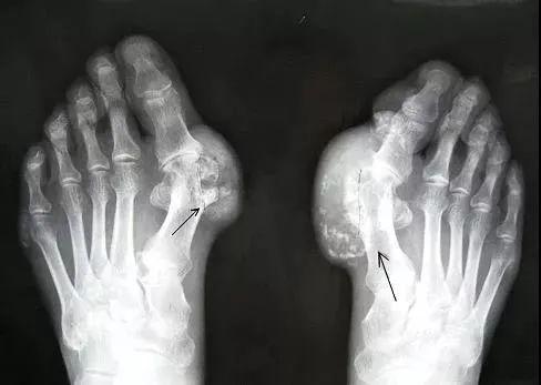 痛风能吃的海鲜，糖尿病能吃的水果……大部分人都不知道