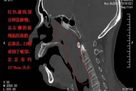 罕见巨大鼻息肉竟从鼻子卡入喉咙，医生另辟蹊径帮老人脱险图片