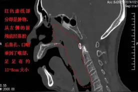 罕见巨大鼻息肉竟从鼻子卡入喉咙，医生另辟蹊径帮老人脱险图片