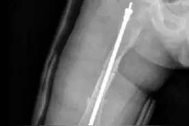 3岁“瓷娃娃”多次骨折，医生植入可延长髓内钉变“钢铁侠”图片