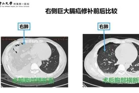 内脏竟然会“跑路”？为了减掉肚腩，中年男子“用力过猛”后悲剧了……图片