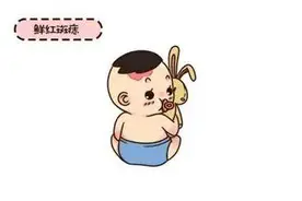 济南童康儿童医院专家讲解：鲜红斑痣是怎么回事？图片