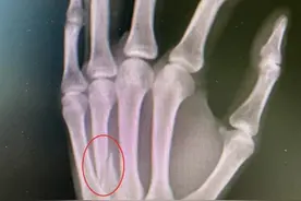 儿子写作业时玩手机，爸爸一拳挥过去，啪一声，骨折了……图片