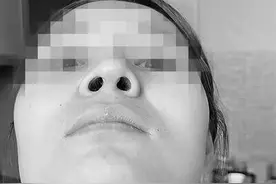 24岁女孩做隆鼻手术 没想到把鼻子整歪了图片