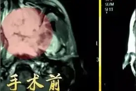 鼻子出血可能是肿瘤前兆吗？图片