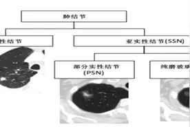 恶性肺结节究竟有哪些特征？专家教你规范诊断图片