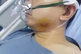 挤了一下脸上的“痘痘”，湖南小伙出现败血症、呼吸衰竭、尿毒症图片