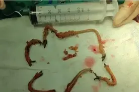 28厘米电线蜗插入尿道两年，医生手术取出时长满结石图片