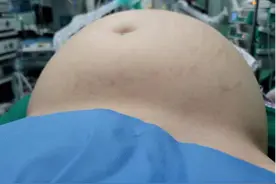 未婚姑娘腹大如孕妇以为发胖，到医院一查：肚子装了一大桶“水”图片