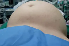 未婚姑娘腹大如孕妇以为发胖，到医院一查：肚子装了一大桶“水”图片