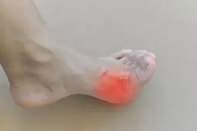 尿酸升高时，身体会有3个表现，牢记“3勤3戒”，远离痛风图片