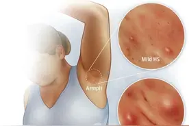 化脓性汗腺炎图片