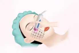 如何判断自己是否适合做热玛吉图片