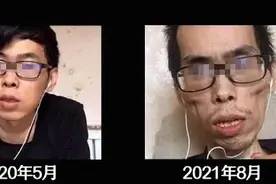 肠癌一年，年轻小伙面目全非！癌症的可怕，让你来不及说后悔图片