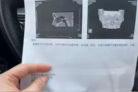 整容还是毁容？女子花2万多元矫正鼻子，结果……图片