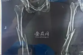 合肥一女子瑜伽课上被教练压腿致粉碎性骨折 店家：通过法律途径解决图片