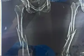 女子称被私教压腿至粉碎性骨折仅获赔5万，双方已委托律师图片