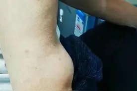 老人右胳膊鼓起大包似“大力水手”，原是每天做这个运动导致肌腱断裂图片
