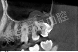 别人拔智齿只要几百块，我拔智齿却很贵，是我被坑了吗？图片