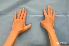 妙手回春！脚趾移植到手上变大拇指，男子断指成功“复活”图片