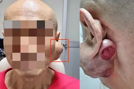 耳后长“土豆”20多年成恶性肿瘤，医生：发现这个尽早就医图片