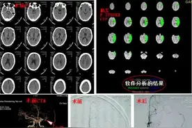 脑玺F-STROKE 卒中影像系统 卒中医生明亮的眼睛——省中医院脑病三科（脑血管病科）成功救治一例急性超时间窗卒中患者图片