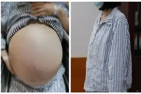 25岁女子肚大如足月孕妇 竟是50斤重的卵巢肿瘤在作祟图片