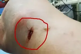 台州男子散步时被超级毒蛇咬了一口！自己一通神操作后得以自救图片