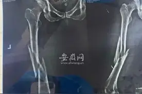 女子第1次上瑜伽课被老师压断腿图片