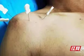 南华医院疼痛康复科：神奇小针刀，精准“秒杀”患者疼痛图片