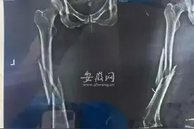 上瑜伽课被教练压断腿！店家想赔5万元了事图片